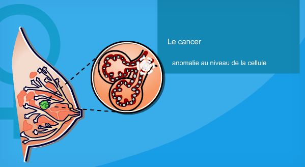 Cancer du sein, ce qu'il faut savoir